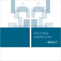 Normal Radiology: CT Brain